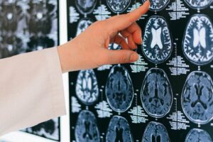 Different Types of Traumatic Brain Injuries Explored
